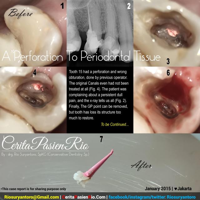 dokter gigi rio spesialis konservasi gigi jakarta indonesia perawatan saluran akar endodontic protaper 3m tambalan estetik kosmetik pulpa dentin email (22)