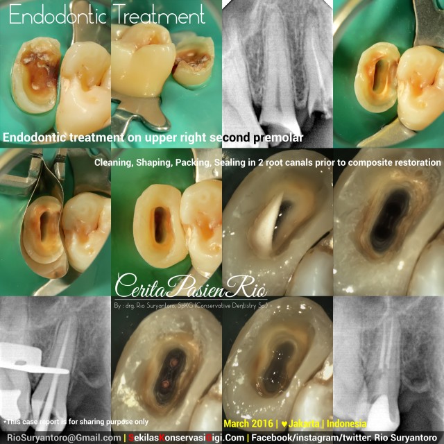 dokter gigi rio suryantoro spesialis konservasi gigi 15 all care pondok indah bagus sakit gigi