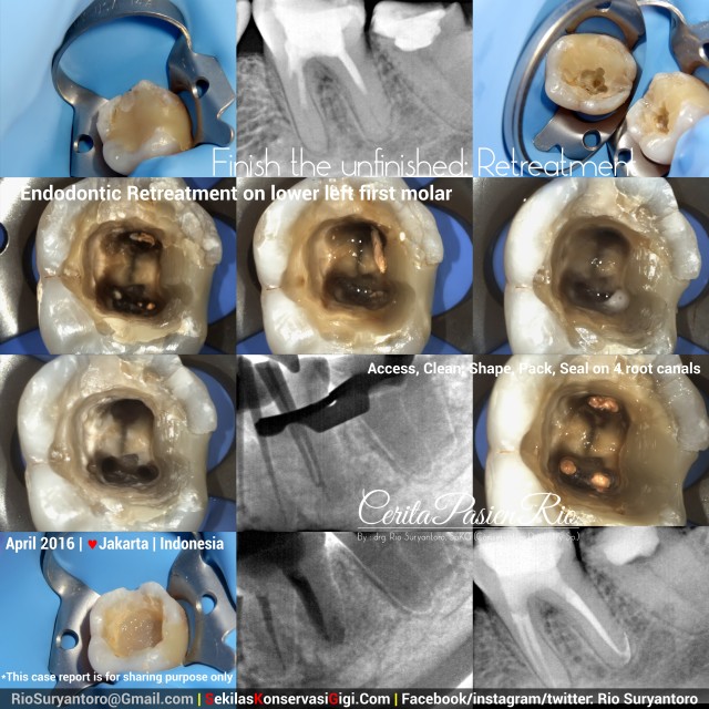 dokter gigi rio spesialis konservasi gigi dentsply 3m filtek bulkfill protaper next april2016 irma