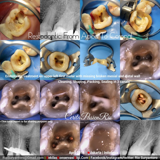 dokter gigi spesialis konservasi gigi terbaik di jakarta perawatan endodontik gigi molar 1 atas kiri april