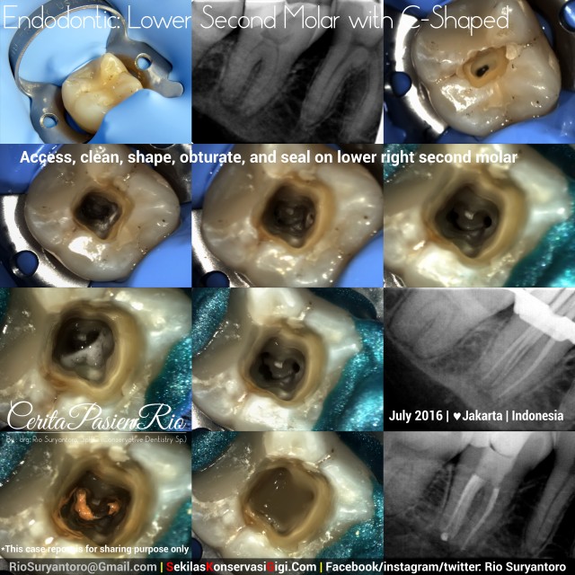 dokter gigi rio suryantoro spesialis konservasi gigi terbaik jakarta PSA 47 4 sal c shaped